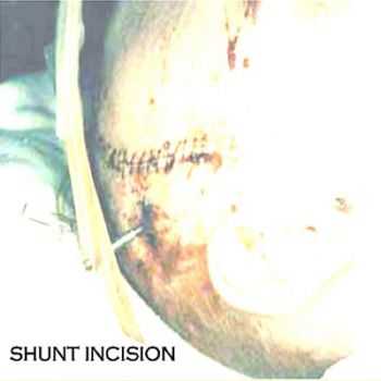 Shunt Incision - Shunt Incision (2003)