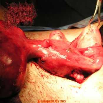 Endocrine Surgery For Prolapsed Uterus - Prolapsed Cervix (Single) (2013)