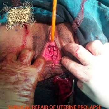 Larvae-Affected Cerebral Liquidization - Surgical Repair of Uterine Prolapse (2013)