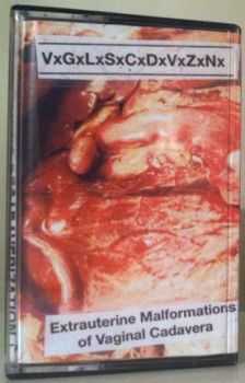 VxGxLxSxCxDxVxZxNx - Extrauterine Malformations Of Vaginal Cadavera (2013)