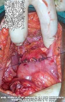 Ripping Off Your Herpe Scabs With a Power Sander - Severe Inflammation of the Gallbladder Due to a Failed Duodenoduodenostomy Procedure for a Metastatic Infection in the Duodenum (2013)