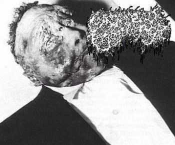 Gangrenous Erythromelalgia - Xeroderma (EP) (2015) Gangrenous Erythromelalgia - Xeroderma (EP) (2015)