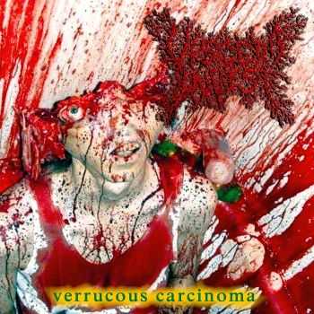 Viscera Infest - Verrucous Carcinoma (2015)