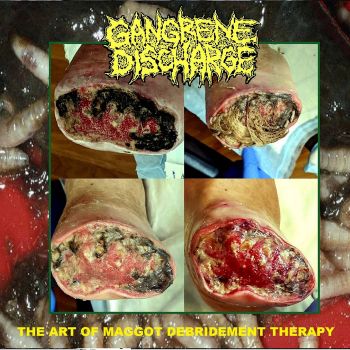 Gangrene Discharge - The Art of Maggot Debridement Therapy (2024)