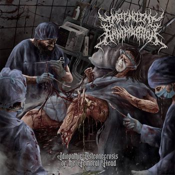 Impending Annihilation - Idiopathic Osteonecrosis of the Femoral Head (2024)