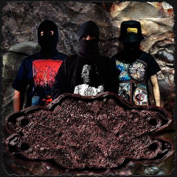 Metastasis Rectal - Adenocarcinoma (2025)