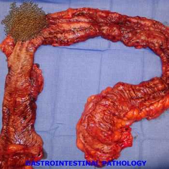 Pathological Infection Of The Pancreas - Gastrointestinal Pathology (EP) (2013)