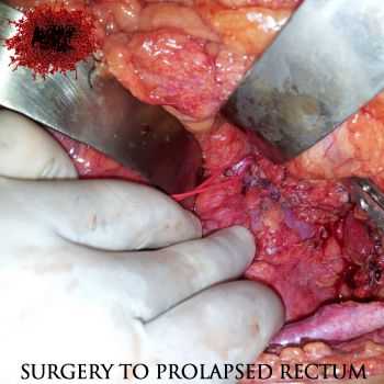 Autopsy Festival - Surgery To Prolapsed Rectum (2013)