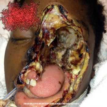 Nasopharyngeal Carcinoma Of The Mucosal Epithelium In The Nasopharynx - Degenerative Secretion Of Blocked Urinary Content (2013)