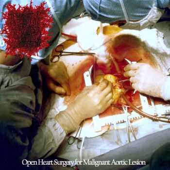 Harmonious Tones of Shattered Bones - Open Heart Surgery for Malignant Aortic Lesion (2013)