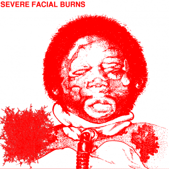 Harmonious Tones of Shattered Bones - Severe Facial Burns (2013)