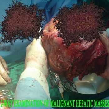 Urethral Lymphoma & Lymphatic Blastoma - 2-Way Examination Of Malignant Hepatic Masses (Split) (2013)