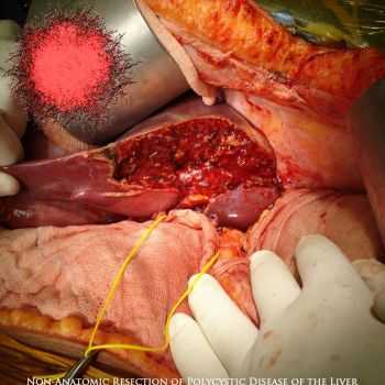 Liquified Cerebrum Severity - Non-Anatomic Resection of Polycystic Disease of the Liver (2013)