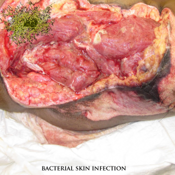 Staphylococcus Saprophyticus - Bacterial Skin Infection (2013)