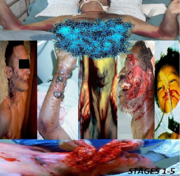 Ebola Pandemic - Stages 1-5 (EP) (2013)