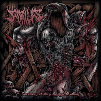 Syphilis - Coronary Artery Bypass Grafting (2019)