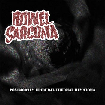 Bowel Sarcoma - Postmortem Epidural Thermal Hematoma (2019)