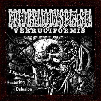 Epidermodysplasia Verruciformis - 3 Episodes of Festering Delusion (2022)
