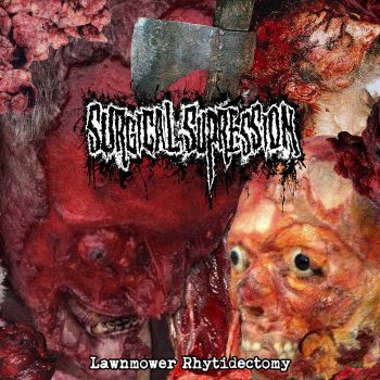 Surgical Supression - Lawnmower Rhytidectom (2022)