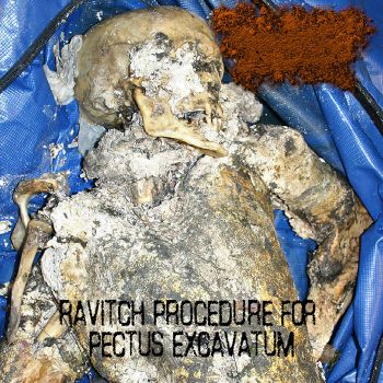 Meningococcemia - Ravitch Procedure for Pectus Excavatum (2022)