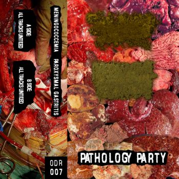 Meningococcemia / Paroxysmal Gastritis - Pathology Party (2022)