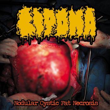 Lipoma - Nodular Cystic Fat Necrosis (2022)