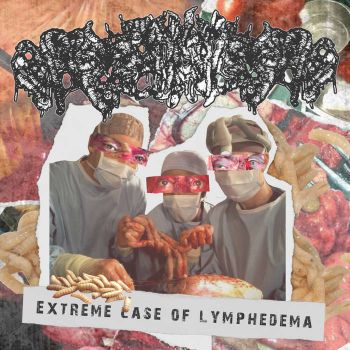 Hodgkin's Lymphoma - Extreme Case of Lymphedema (2022)