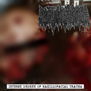 Cystic Hygroma - ?Intense Degree of Maxillofacial Trauma (2022)