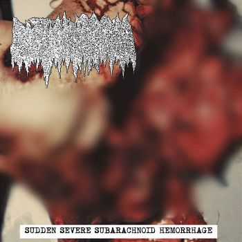 Cystic Hygroma - Sudden Severe Subarachnoid Hemorrhage (2022)
