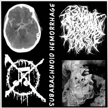Alkaline Phosphatase - Subarachnoid Hemorrhage (2022)