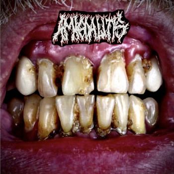 Amigdalitis - Tonsilolitos y Sus Consecuencias (2023)