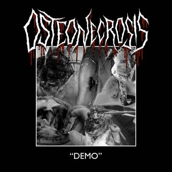 Osteonecrosis - Demo (2023)