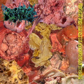 Excremental Carnage - The Gross Appeareance for Multicystic Renal Dysplasia (2023)