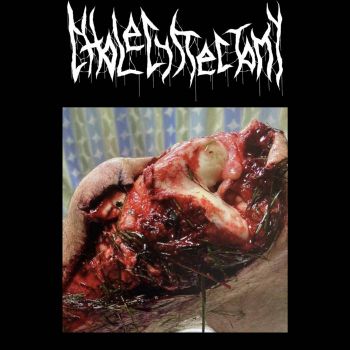Cholecystectomy - Cholecystectomy (2023)