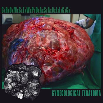 Complete Resection of Mature Cystic Teratoma with Preservation of Adnexal Structures and Ovarian Function in Gynecological Cases (CxRxOxMxCxTxWxPxOxAxSxAxOxFxIxGxCx) - Gynecological Teratoma (2023)