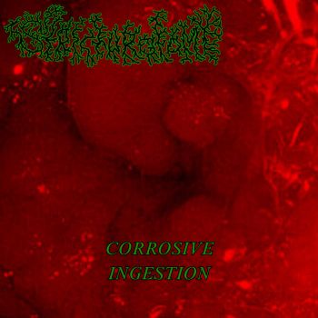 Stricturotomy - Corrosive Ingestion (2023)