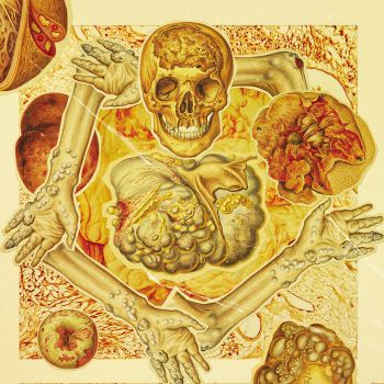 Gastrointestinal Stromal Tumor (GIST) - A Postmortem Diagnosis of Malignant Submucosal Tumors (2024)