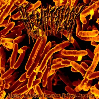 Hematology - Abdominal Tuberculosis Complicated by Bowel Perforation (2025)