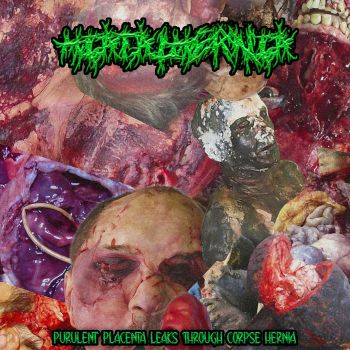 HiatalHernia - Purulent Placenta Leaks Through Corpse Hernia (2025)