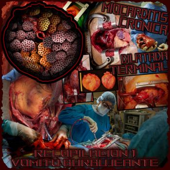 Miocarditis Cronica Dilatada Terminal - Recopilacion 1 Vomito Burbujeante (2025)