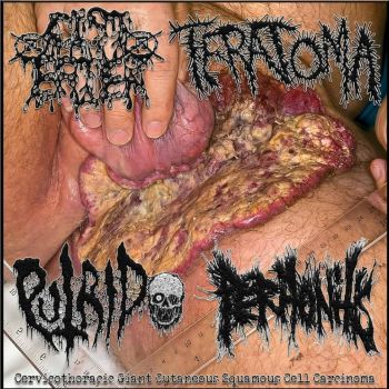 Cyst Eater / Teratoma / Putrido / Peritonitis - Cervicothoracic Giant Cutaneous Squamous Cell Carcinoma (2025)