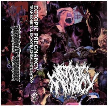 Ectopic Pregnancy - Transorbital Endotracheal Intubation (2025)