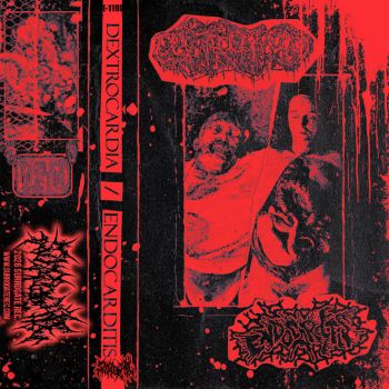Dextrocardia / Endocarditis - Split (2025)