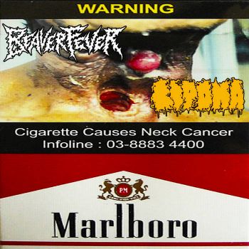Beaver Fever / Lipoma - Cigarette Causes Neck Cancer (2025)