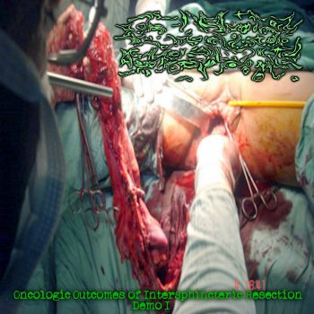 Uncontrolled Mucopexy - Oncologic Outcomes of Intersphincteric Resection (2026)