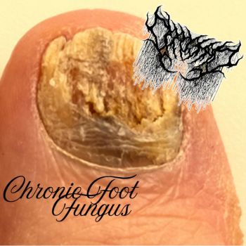 Deformed - Chronic Foot Fungus (2026)