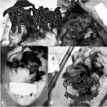 Trauma - Charred Corpses with Proliferation of Pus and Advanced State of Gangrene (2026)