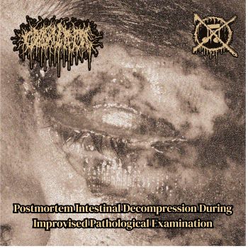 Casentrino - Postmortem Intestinal Decompression During Improvised Pathological Examination (2026)
