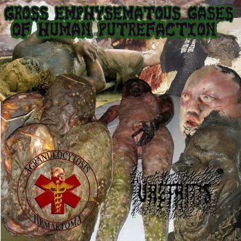 Agronulocytosis Hemertoma / Uretritis - Gross Emphysematous Gases of Human Putrefaction (2026)