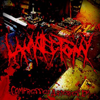 Laminectomy - Compressed Arteries (2026)